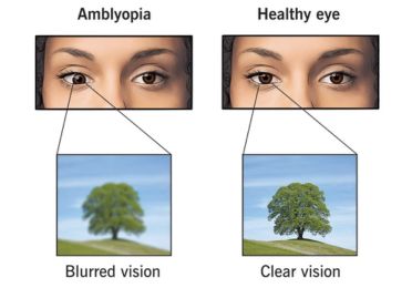 Amblyopia Lazy Eye
