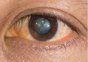 Cataract
