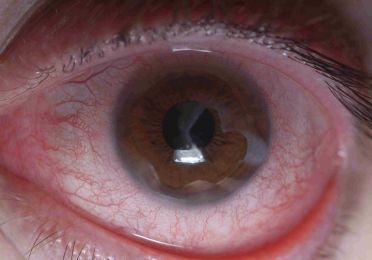 Diabetic Retinopathy