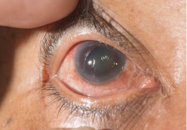 Glaucoma